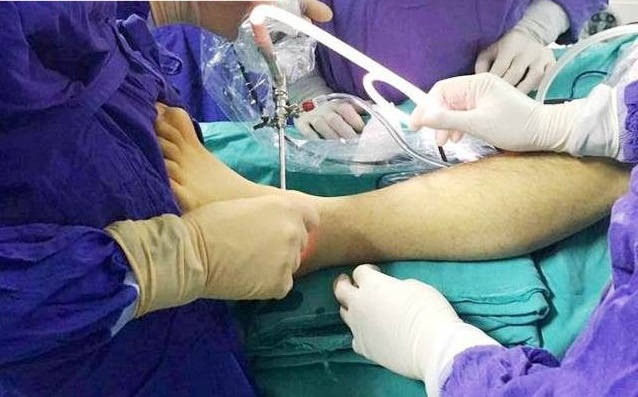 Xử trí phẫu thuật giải ép thành phần bên trong ống cổ chân